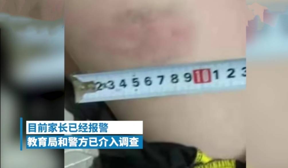 山东54名小学生遭教师体罚：全班趴操必一体育场上挨打棍子打成三截肿得不能碰(图5)