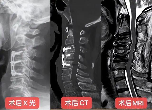 广东65岁男子颈必一运动官方网站椎管内长满“石头”险些瘫痪罪魁祸首竟是它！(图5)