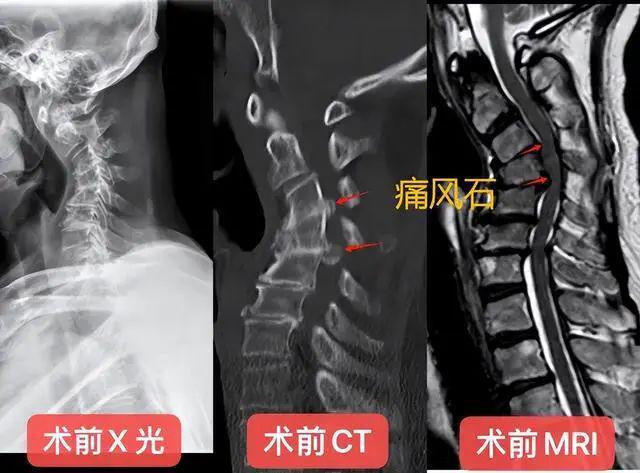 广东65岁男子颈必一运动官方网站椎管内长满“石头”险些瘫痪罪魁祸首竟是它！(图4)